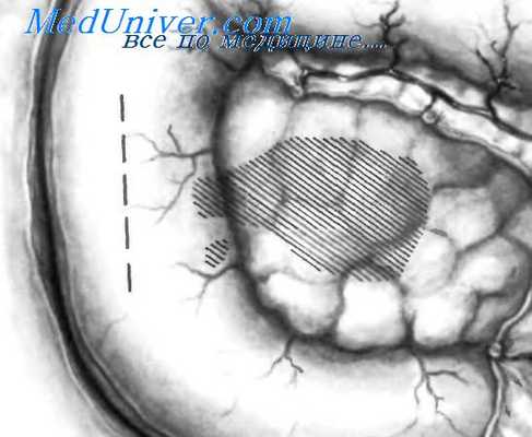 дивертикулы двенадцатиперстной кишки
