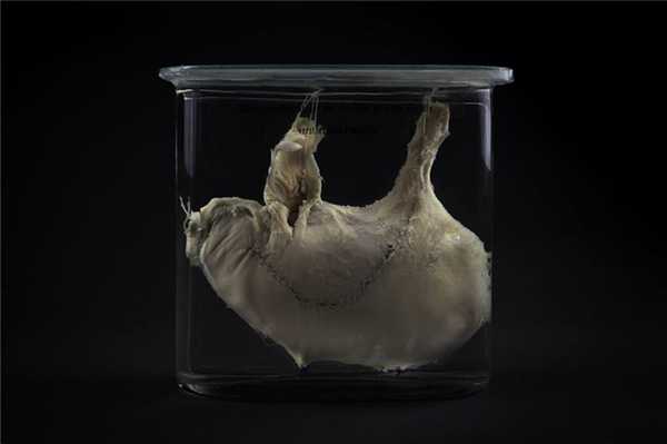 Секционный препарат: оперированный желудок Терезы Хеллер, умершей от метастазов 23 мая 1881 года. Музей Йозефиниум, Вена.