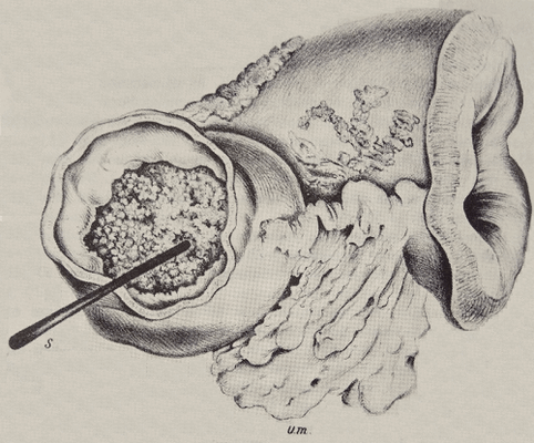 14-сантиметровый отрезок желудка с карциномой, удалённый 29 января 1881. Рисунок Антона Вёльфера, ассистента Бильрота на той операции. Для демонстрации плотности карциномы, забившей просвет желудка, показан кончик птичьего пера, который удавалось погрузить в массу опухоли только с большим усилием.