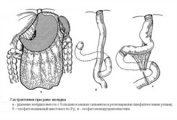 Гастректомия