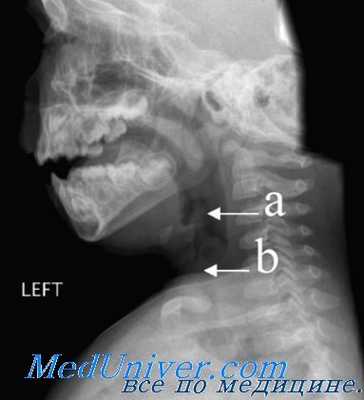 резонаторная функция гортани