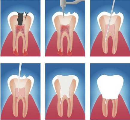 Этапы эндодонтического лечения