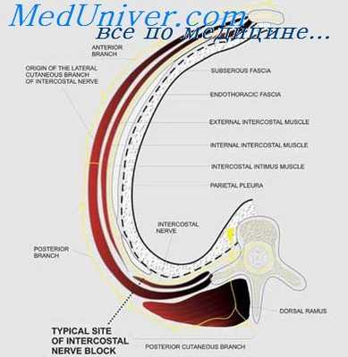 блокада межреберных нервов
