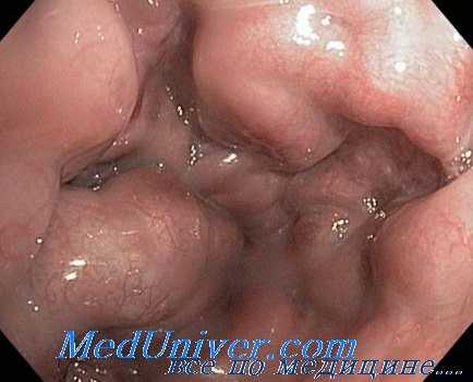 азигопортальное разобщение