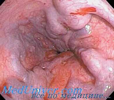 азигопортальное разобщение