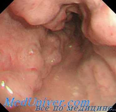 портальная гипертензия