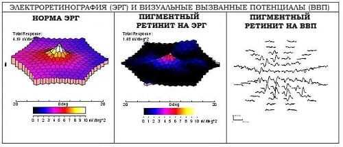Картирование сетчатки при электроретинографии