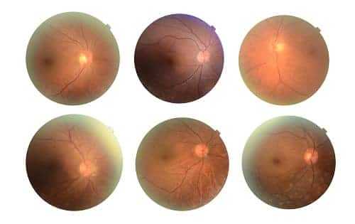 Варианты диабетической ретинопатии