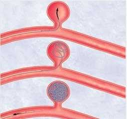 Схема эмболизации аневризмы