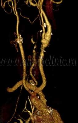 Аневризма общей сонной артерии