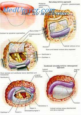 фенестрация лабиринта
