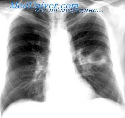 каверны легкого