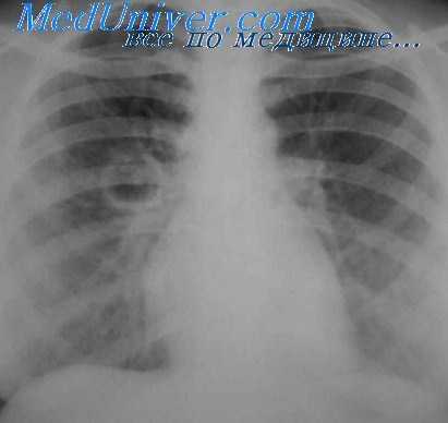 классическая кавернотомия