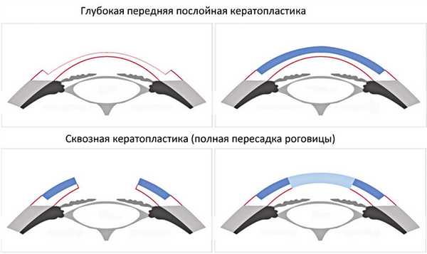 Лечение помутнения роговицы (бельма) в клинике в Москве