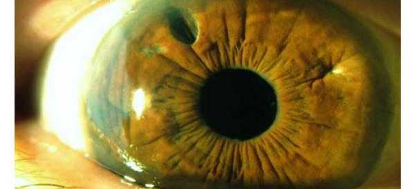 глаз без хрусталика