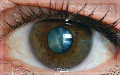 Лечение травматической катаракты в Москве