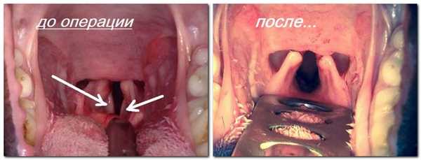удаление голосовых связок