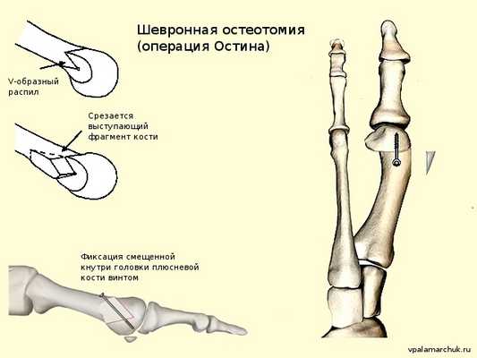Операция Остина шевронная остеотомия