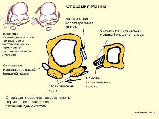 операция на мягких тканях Hallux valgus