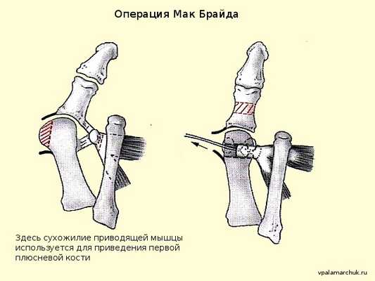 операция Мак Брайда Mc.Bride Hallux valgus