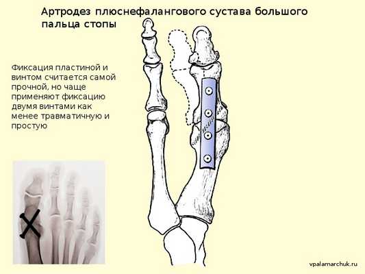 артродез вальгусная деформация Hallux valgus