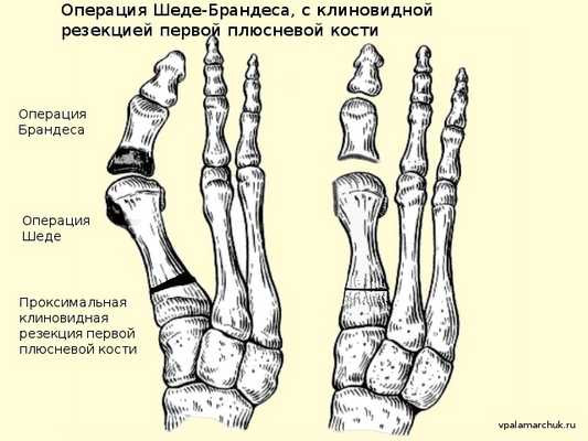 Операция Шеде Брандеса Hallux valgus