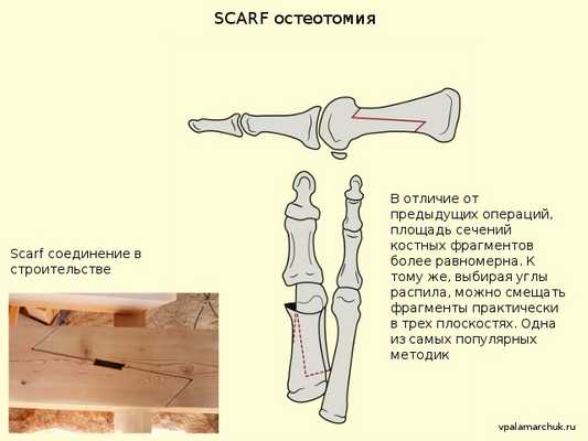 скарф scarf операция вальгусная деформация