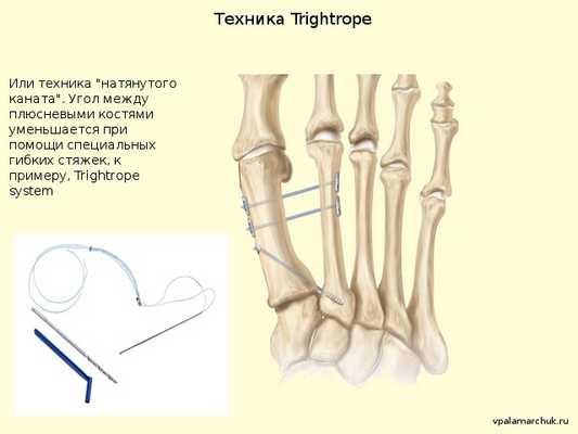 стяжки пр ивальгусной деформации