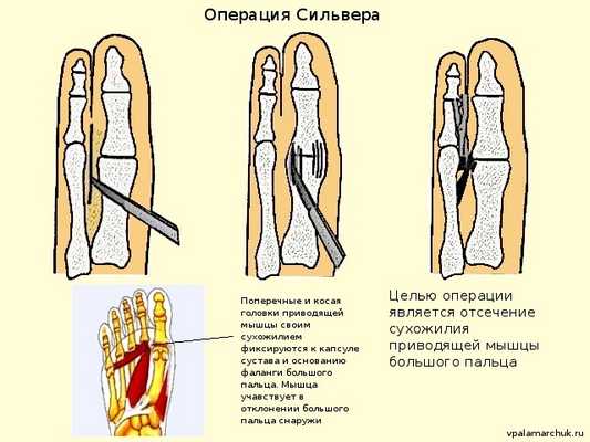 операция Сильвера Silver Hallux valgus