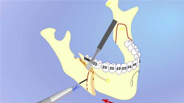 остеотомия нижней челюсти.jpg