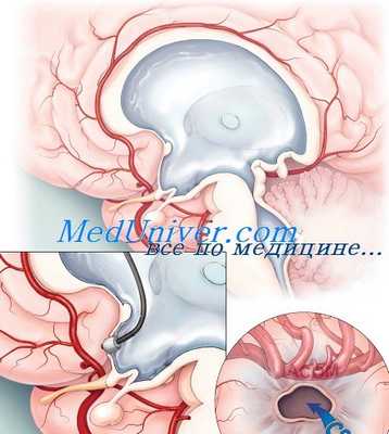 шунтирование гидроцефалии