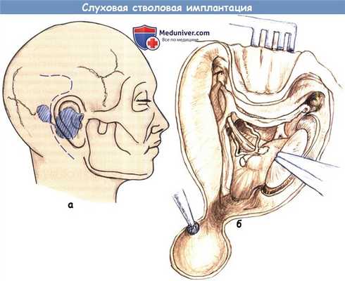 Слуховая стволовая имплантация