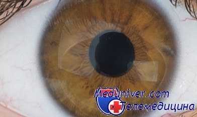 витрэктомия при отслойке сетчатки