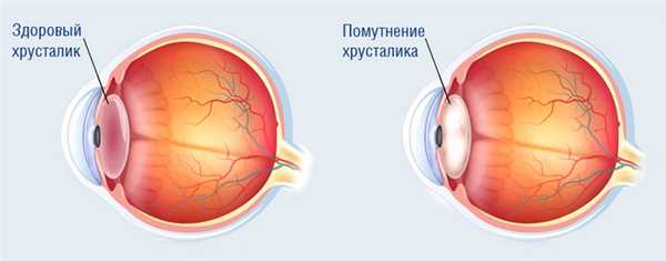 катаракта и здоровый глаз