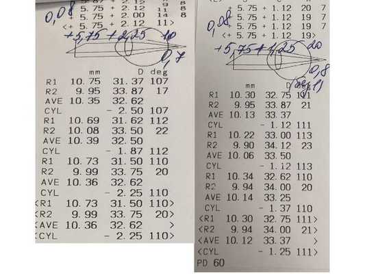 Зрение до операций