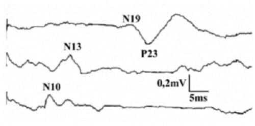 График ССПВ с правой руки у больного с травмой головы