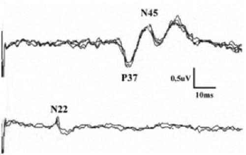 График ССВП с правого большеберцового нерва при рассеянном склерозе