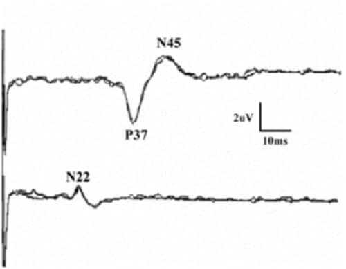 График ССВП с правого большеберцового нерва