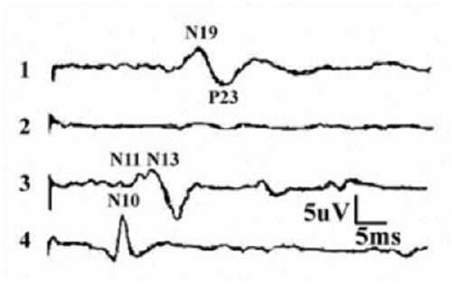Графики нормальных ССВП с разных триггерных участков