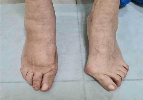 хирургическая коррекция тяжелого халюс вальгус