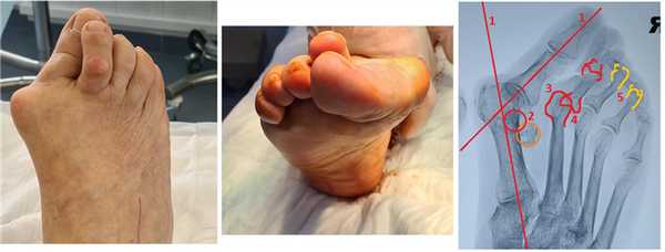 косточка на большом пальце ноги тяжёлый случай