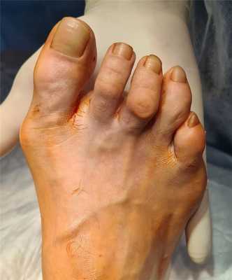 Косточка на большом пальце ноги тяжёлый вариант 