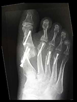 операция hallux valgus