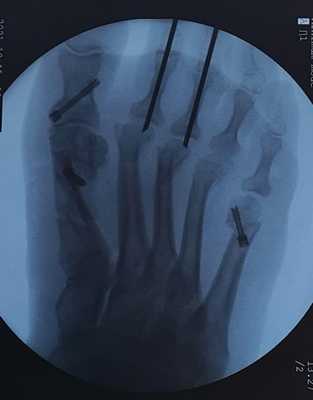 Коррекция молоткообразной деформации пальцев