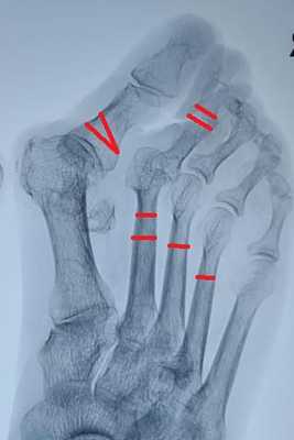 операция при молоткообразной деформации пальцев