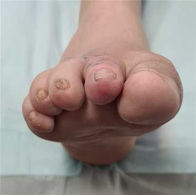 хирургическая коррекция тяжёлого поперечного плоскостопия