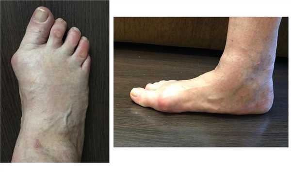 халюс вальгус 3 степени 