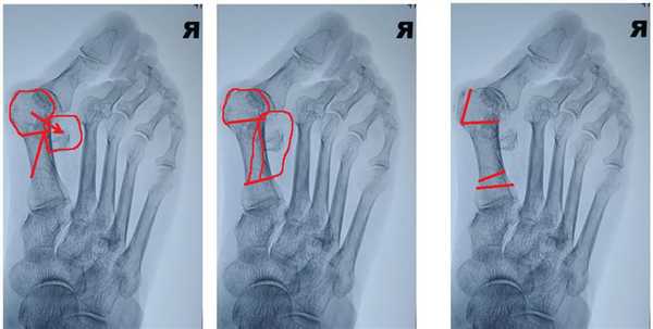 коррекция тяжёлого поперечного плоскостопия