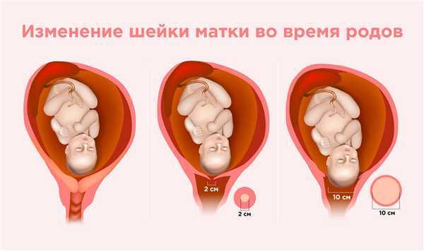 Изменения шейки матки во время родов