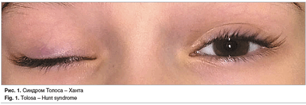 Рис. 1. Синдром Толоса - Ханта Fig. 1. Tolosa - Hunt syndrome